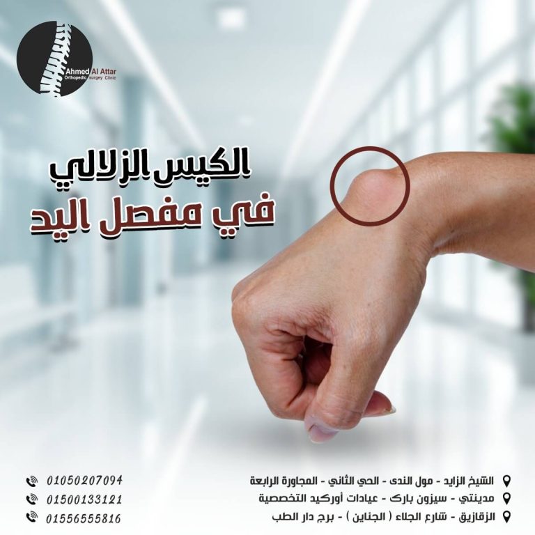 الكيس الزلالي في مفصل اليد