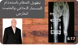 تطويل العظام باستخدام المسمار النخاعي والمثبت الخارجي