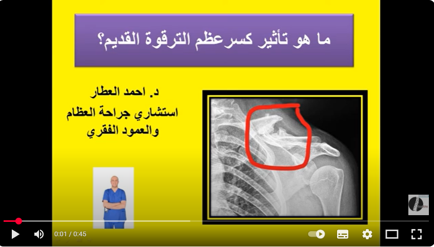 ما هو تأثير كسرعظم الترقوة القديم؟