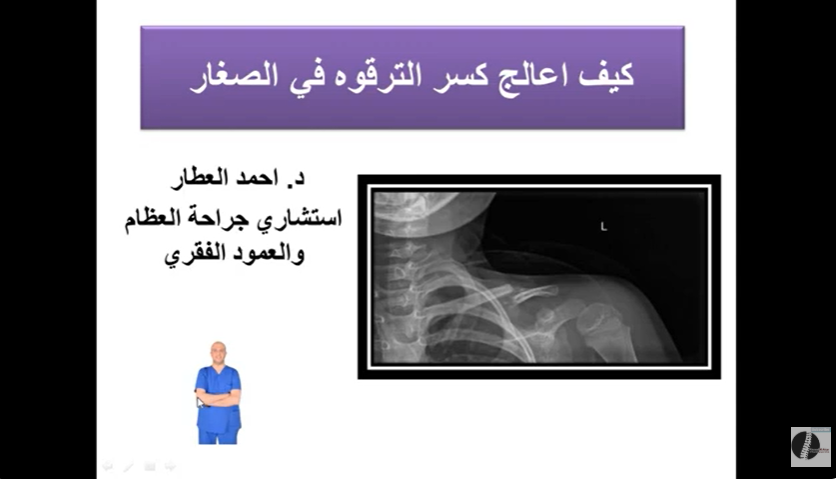 كيف اعالج كسر الترقوه في الصغار