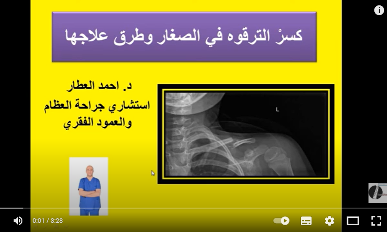 كسرْ الترقوه في الصغار وطرق علاجها