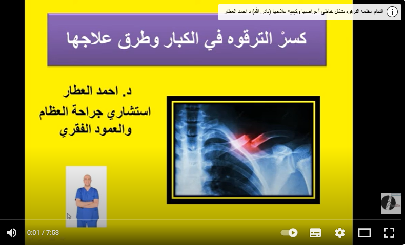 كم يستغرق شفاء كسر الترقوة؟