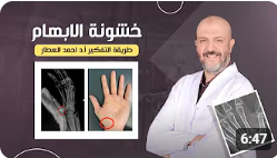 خشونة مفصل الابهام طريقة التفكير للدكتور احمد العطار