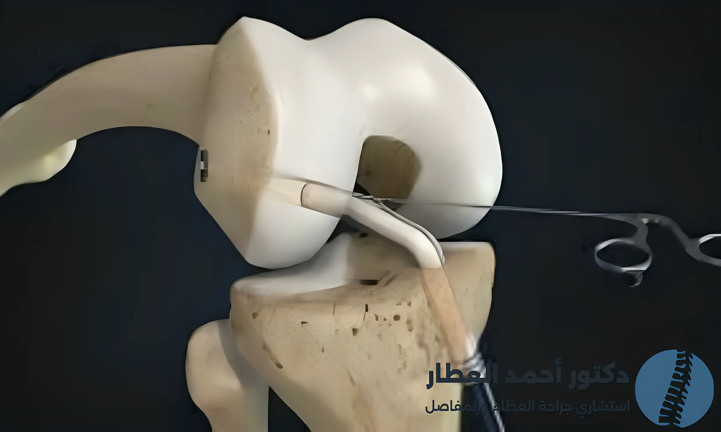 عملية الرباط الصليبي بالمنظار