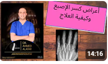 أعراض كسر الإصبع وكيفية العلاج - د احمد العطار