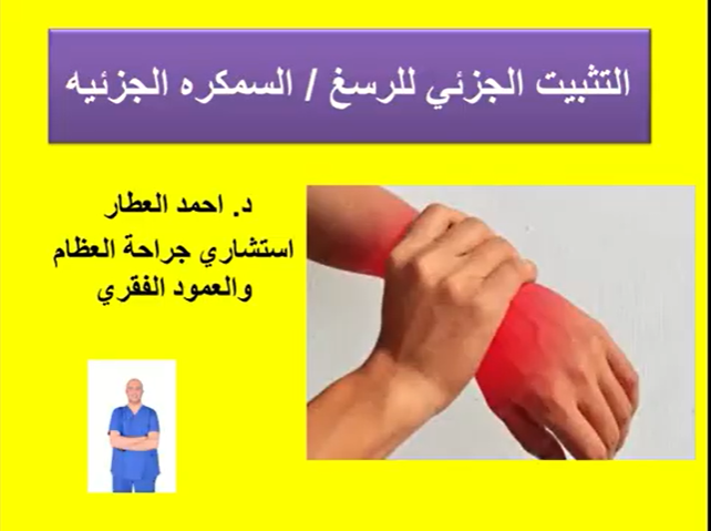 التثبيت الجزئي للرسغ/ السمكره الجزئيه للدكتور احمد العطار