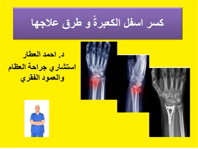 كسر اسفل الكعبرةْ و طرق علاجها للدكتولر احمد العطار