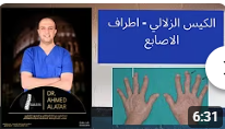 الكيس الزلالي - اطراف الاصابع