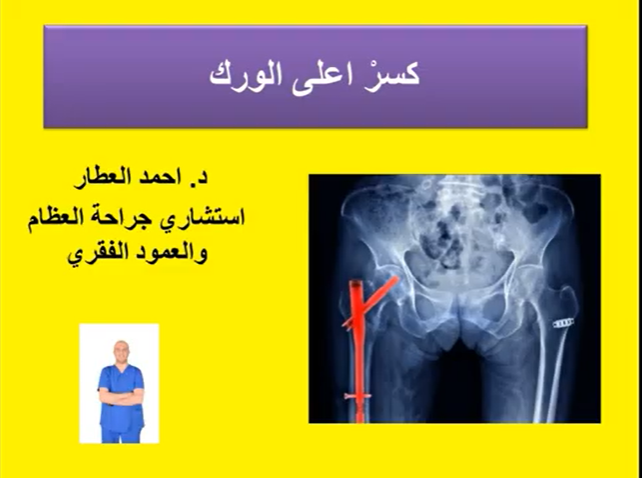 كسرْ اعلى الورك للدكتور احمد العطار