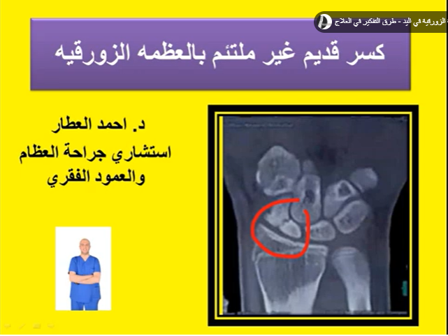 كسر قديم غير ملتئم بالعظمه الزورقيه