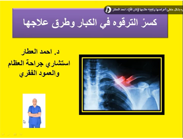 كسرْ الترقوه في الكبار وطرق علاجها