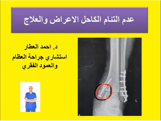 عدم التئام الكاحل الاعراض والعلاج للدكتور احمد العطار
