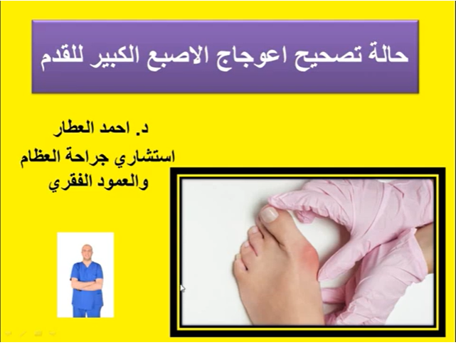 حالة تصحيح اعوجاج الاصبع الكبير للقدم