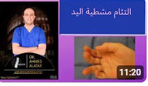 التئام مشطية اليد - انعواج المشطيه بالخطا