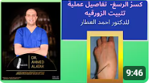 كسرْ الرسغ - تفاصيل عملية تثبيت الزورقيه للدكتور احمد العطار