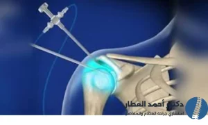 تكلفة عملية منظار الكتف