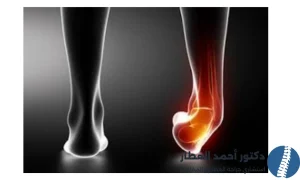 علاج تمزق اربطة الكاحل