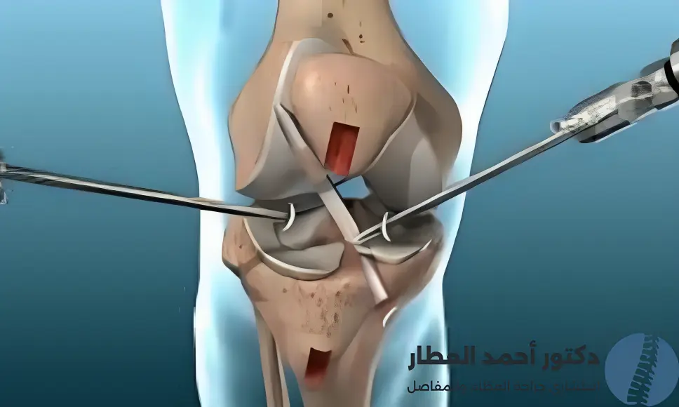 مدة الألم بعد عملية غضروف الركبة بالمنظار