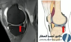 هل يلتئم تمزق الغضروف الهلالي