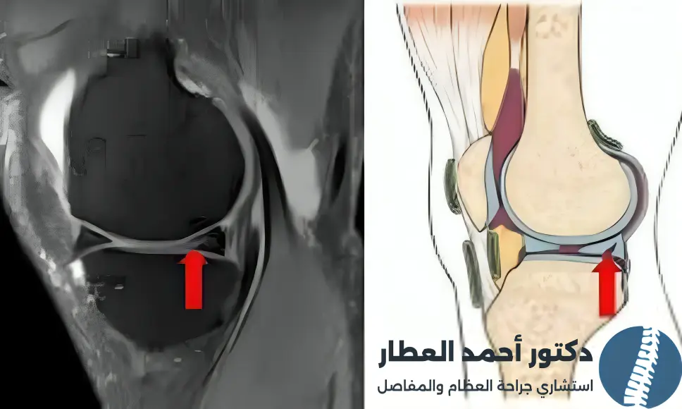 هل يلتئم تمزق الغضروف الهلالي