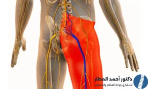 اعراض عرق النسا عند الرجال