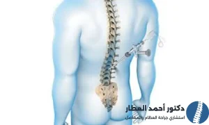 افضل دكتور جراحة العمود الفقري في مصر
