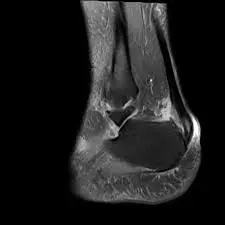 قطع جزئي في وتر اكيلس