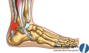 قطع جزئي في وتر اكيلس
