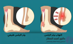 ما هي أعراض التهاب وتر أكيلس