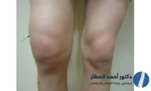 هل وجود الماء في الركبة خطير