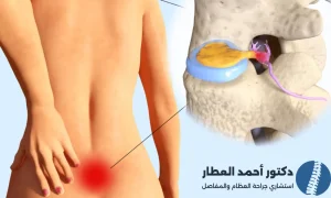 علاج الانزلاق الغضروفي في اسفل الظهر