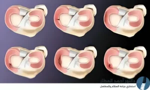قطع غضروف الركبة من الدرجة الثالثة