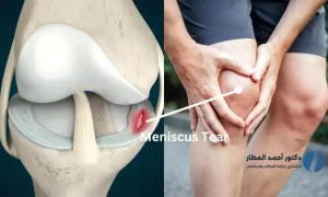 قطع غضروف الركبة من الدرجة الثالثة